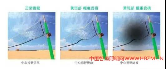 图4黄斑部病变的视觉状况;视觉成像功能已受影响及伤害